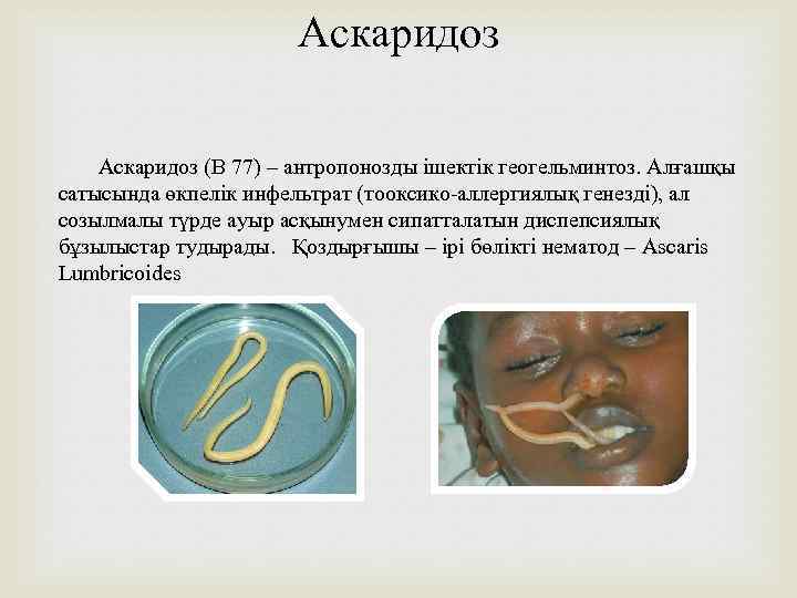 Аскаридоз (В 77) – антропонозды ішектік геогельминтоз. Алғашқы сатысында өкпелік инфельтрат (тооксико-аллергиялық генезді), ал