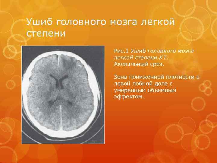 Ушиб головного мозга легкой степени Рис. 1 Ушиб головного мозга легкой степени. КТ. Аксиальный