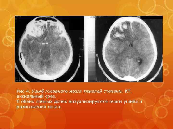 Рис. 4. Ушиб головного мозга тяжелой степени. КТ. аксиальный срез. В обеих лобных долях