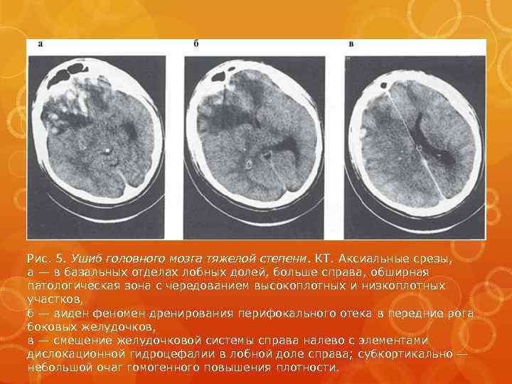 Рис. 5. Ушиб головного мозга тяжелой степени. КТ. Аксиальные срезы, а — в базальных
