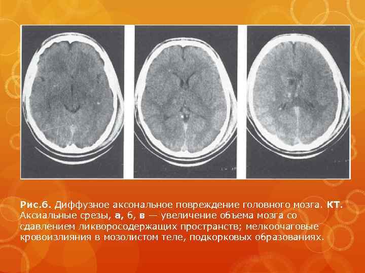 Рис. 6. Диффузное аксональное повреждение головного мозга. КТ. Аксиальные срезы, а, б, в —