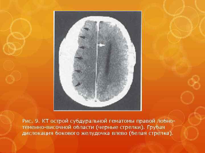 Рис. 9. КТ острой субдуральной гематомы правой лобнотеменно-височной области (черные стрелки). Грубая дислокация бокового