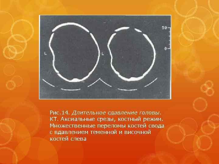 Рис. 14. Длительное сдавление головы. КТ. Аксиальные срезы, костный режим. Множественные переломы костей свода