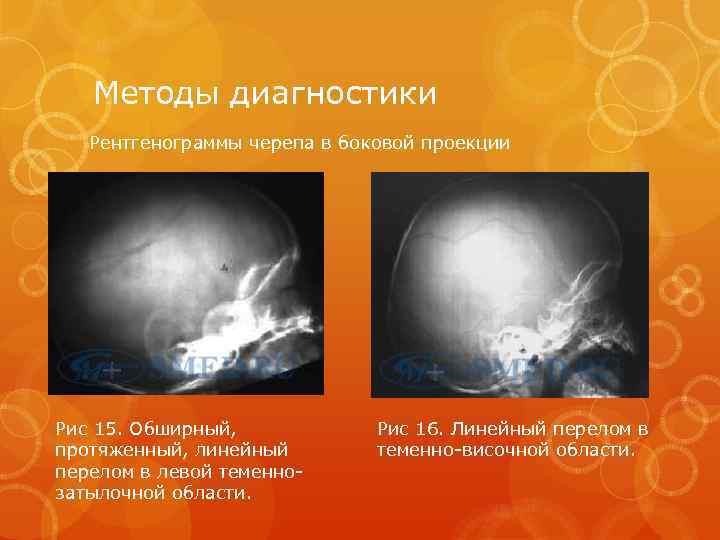 Методы диагностики Рентгенограммы черепа в боковой проекции Рис 15. Обширный, протяженный, линейный перелом в