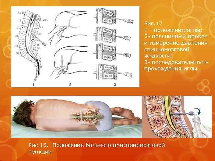 Рис. 17 1 - положение иглы; 2 - поясничный прокол и измерение давления спинномозговой