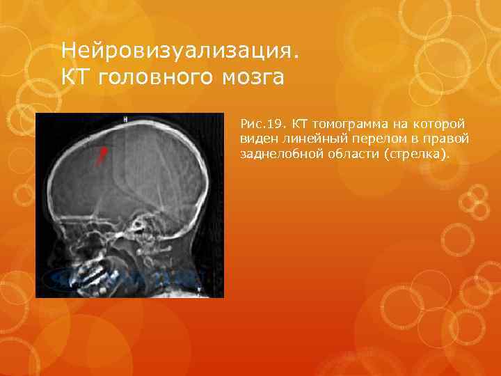 Нейровизуализация. КТ головного мозга Рис. 19. КТ томограмма на которой виден линейный перелом в