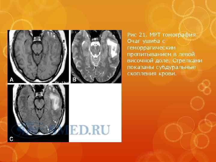 Рис 21. МРТ томография. Очаг ушиба с геморрагическим пропитыванием в левой височной доле. Стрелками