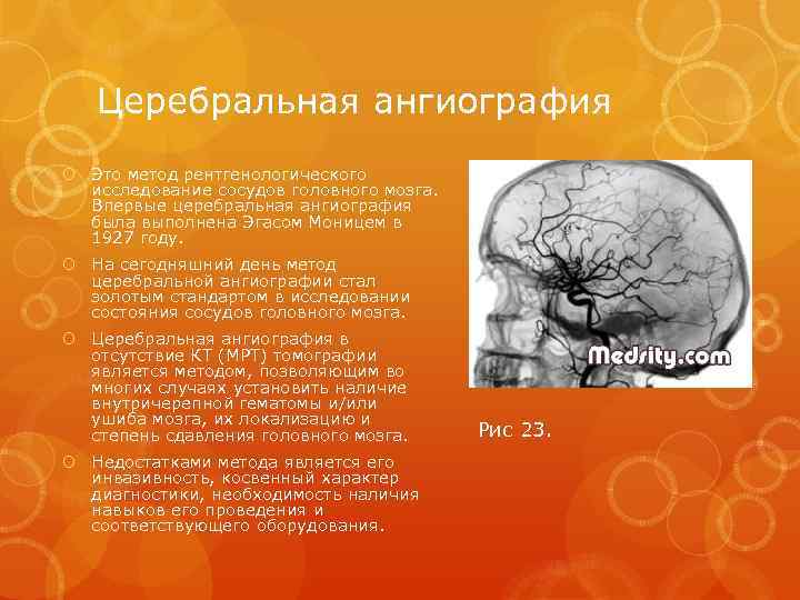 Церебральная ангиография Это метод рентгенологического исследование сосудов головного мозга. Впервые церебральная ангиография была выполнена