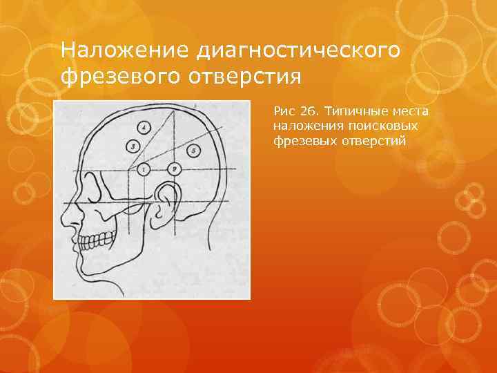 Наложение диагностического фрезевого отверстия Рис 26. Типичные места наложения поисковых фрезевых отверстий 