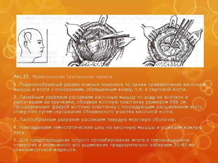 Рис 27. Резекционная трепанация черепа 1. Подковообразный разрез кожных покровов по линии прикрепления височной