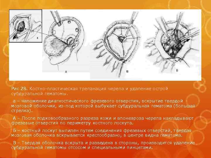 Рис 28. Костно-пластическая трепанация черепа и удаление острой субдуральной гематомы. а – наложение диагностического