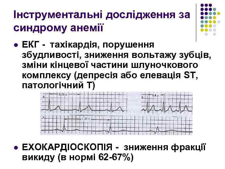 Інструментальні дослідження за синдрому анемії l ЕКГ - тахікардія, порушення збудливості, зниження вольтажу зубців,