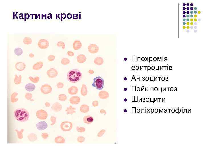 Картина крові l l l Гіпохромія еритроцитів Анізоцитоз Пойкілоцитоз Шизоцити Поліхроматофіли 