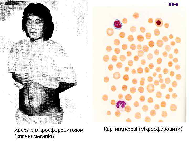Хвора з мікросфероцитозом (спленомегалія) Картина крові (мікросфероцити) 