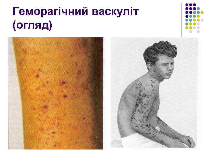 Геморагічний васкуліт (огляд) 