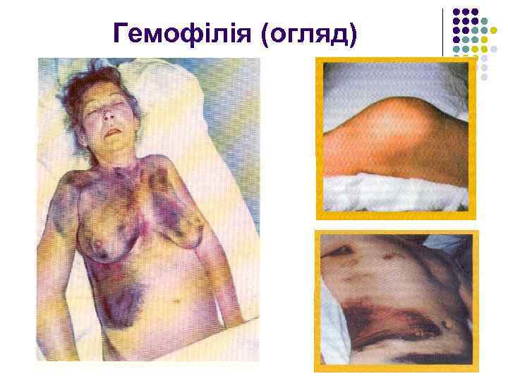 Гемофілія (огляд) 