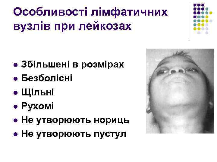 Особливості лімфатичних вузлів при лейкозах l l l Збільшені в розмірах Безболісні Щільні Рухомі