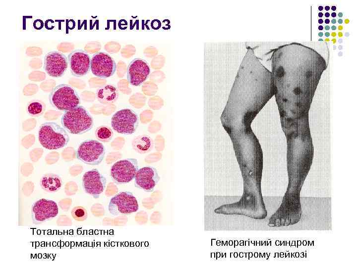 Гострий лейкоз Тотальна бластна трансформація кісткового мозку Геморагічний синдром при гострому лейкозі 