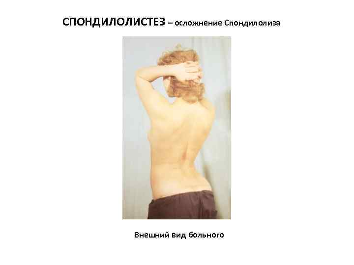 СПОНДИЛОЛИСТЕЗ – осложнение Спондилолиза Внешний вид больного 