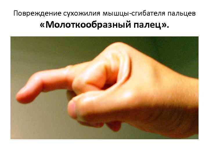 Повреждение сухожилия мышцы-сгибателя пальцев «Молоткообразный палец» . 