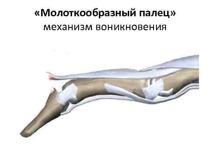  «Молоткообразный палец» механизм воникновения 