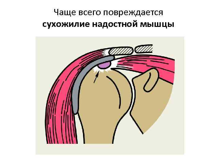 Чаще всего повреждается сухожилие надостной мышцы 