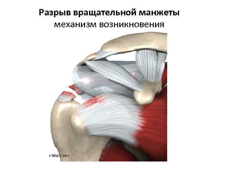 Разрыв вращательной манжеты механизм возникновения 