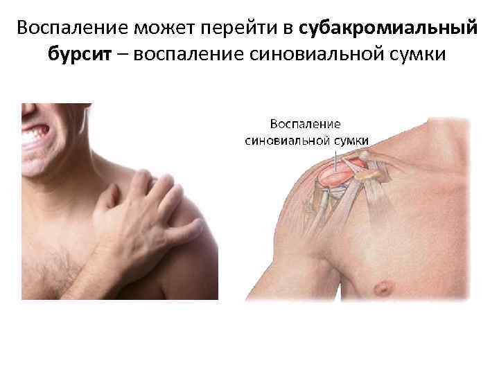Воспаление может перейти в субакромиальный бурсит – воспаление синовиальной сумки 