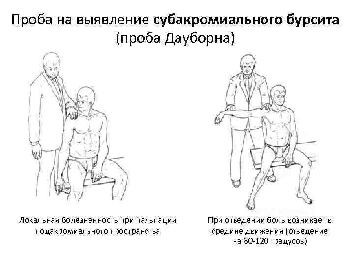 Проба на выявление субакромиального бурсита (проба Дауборна) Локальная болезненность при пальпации подакромиального пространства При