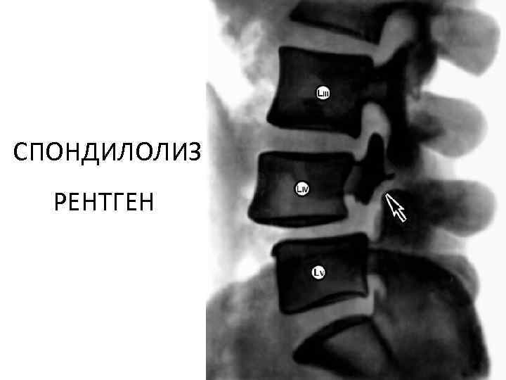 СПОНДИЛОЛИЗ РЕНТГЕН 