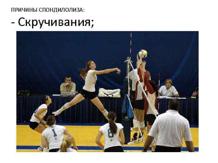 ПРИЧИНЫ СПОНДИЛОЛИЗА: - Скручивания; 