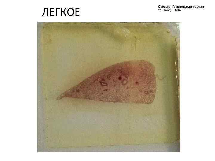 ЛЕГКОЕ Окраска: Гематоксилин-эозин Ув: 10 х8; 10 х40 