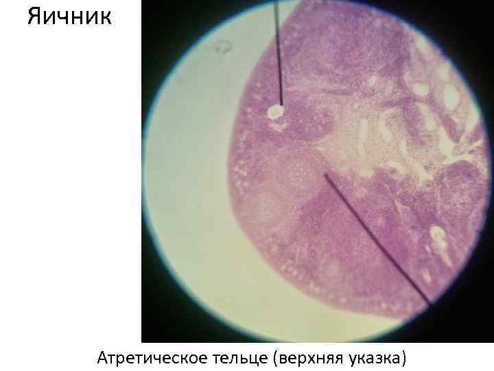 Яичник Атретическое тельце (верхняя указка) 