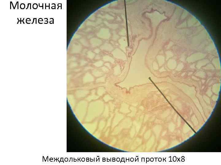 Молочная железа Междольковыи выводнои проток 10 х8 