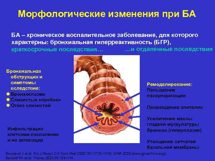 Морфологические изменения при БА БА – хроническое воспалительное заболевание, для которого характерны: бронхиальная гиперреактивность