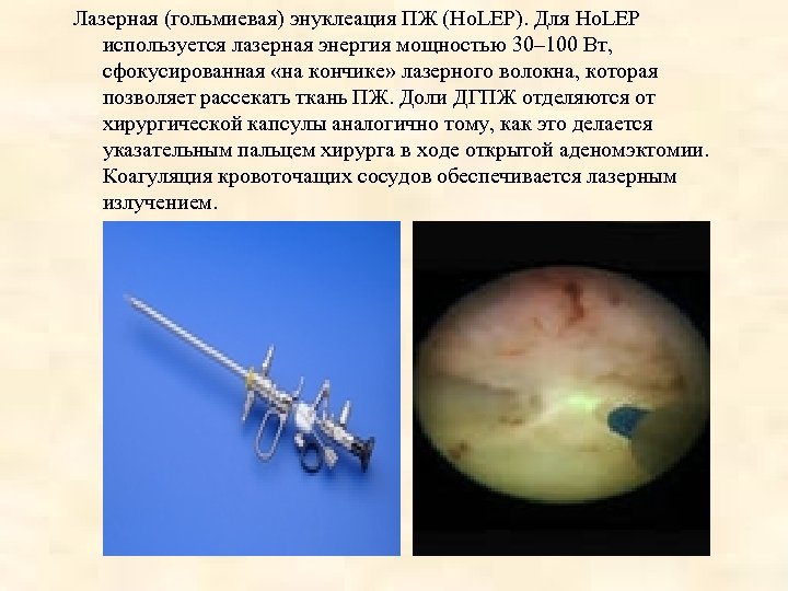 Лазерная (гольмиевая) энуклеация ПЖ (Ho. LEP). Для Ho. LEP используется лазерная энергия мощностью 30–