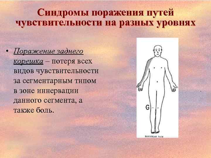 Синдромы поражения путей чувствительности на разных уровнях • Поражение заднего корешка – потеря всех