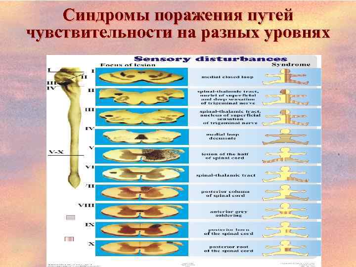 Синдромы поражения путей чувствительности на разных уровнях 