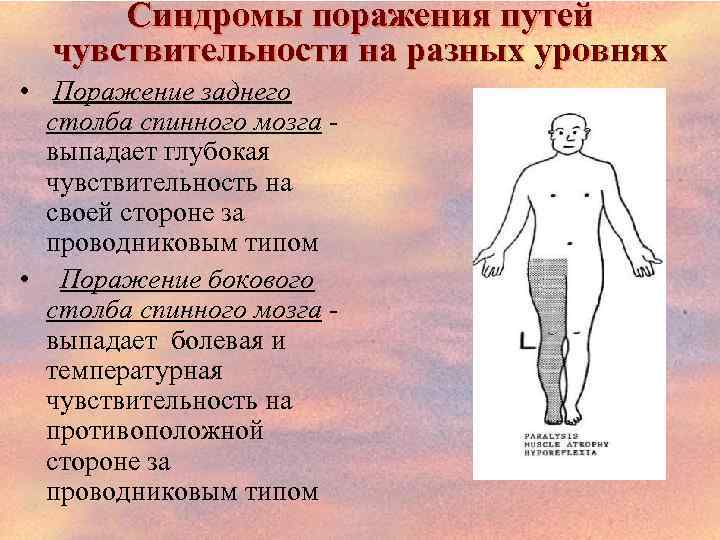 Синдромы поражения путей чувствительности на разных уровнях • Поражение заднего столба спинного мозга выпадает