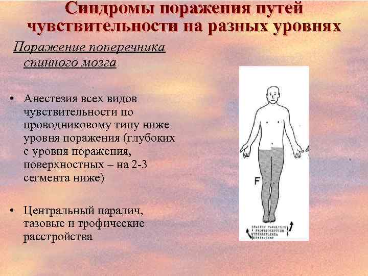 Синдромы поражения путей чувствительности на разных уровнях Поражение поперечника спинного мозга • Анестезия всех