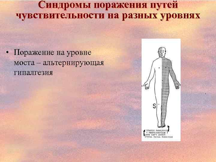 Синдромы поражения путей чувствительности на разных уровнях • Поражение на уровне моста – альтернирующая