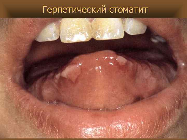 Герпетический стоматит 