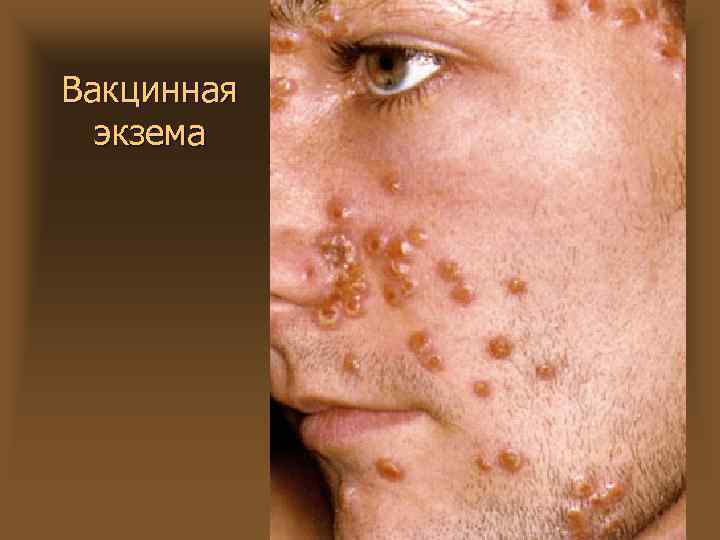 Вакцинная экзема 