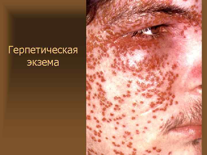 Герпетическая экзема 