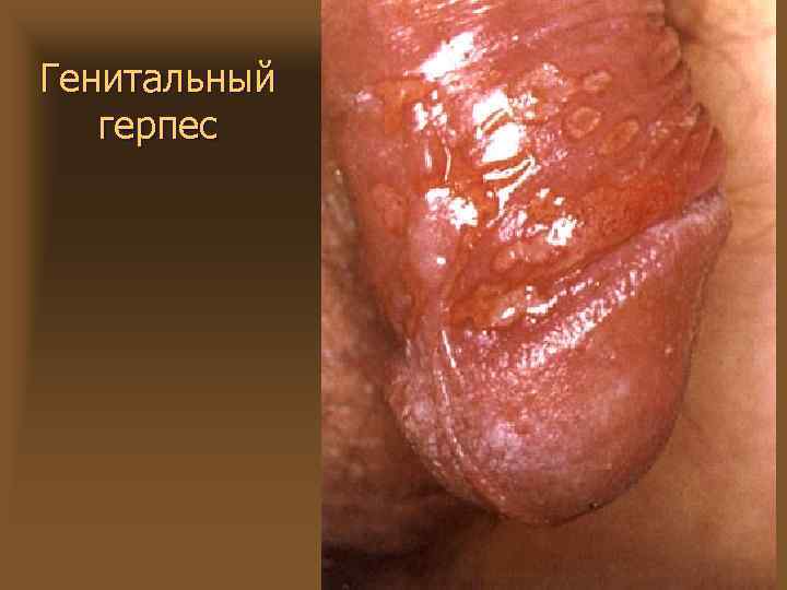 Генитальный герпес 