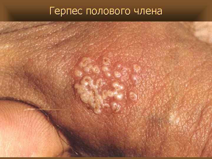 Герпес полового члена 