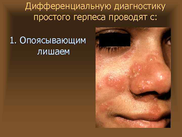 Дифференциальную диагностику простого герпеса проводят с: 1. Опоясывающим лишаем 