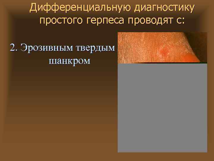 Дифференциальную диагностику простого герпеса проводят с: 2. Эрозивным твердым шанкром 