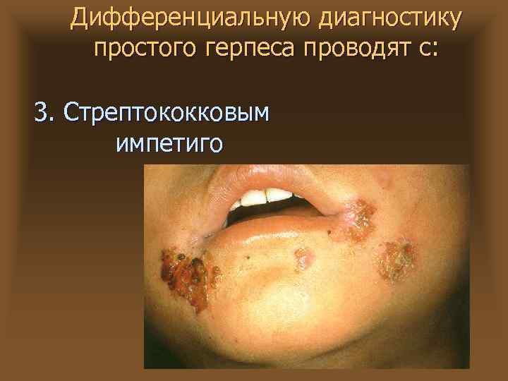 Дифференциальную диагностику простого герпеса проводят с: 3. Стрептококковым импетиго 