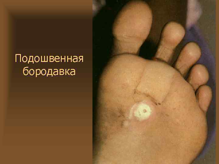 Подошвенная бородавка 